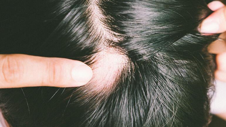 Saç dökülmesini durdurmak için en sık kullanılan yöntemler