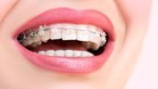 Şeffaf diş teli nedir?