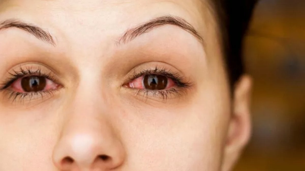 Göz tansiyonu ilerlemesine dikkat: Körlüğe neden olabilir #1
